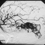 arteriografia-mav Conozca la Unidad de Neurocirugia RGS-arteriografia-mav