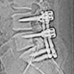 tac-cirugia-columna-cervical Conozca la Unidad de Neurocirugia RGS-tac-cirugia-columna-cervical