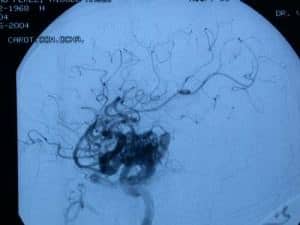 arteriografia-cerebral-malformacion-arteriovenosa Informacion al paciente - temas generales - exploración neurológica - arteriografia-cerebral-malformacion-arteriovenosa