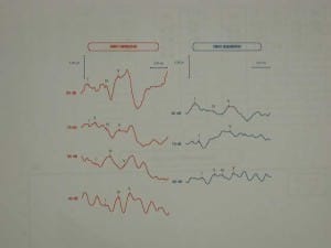 exploracion-nervio-acustico Informacion al paciente - temas generales - exploración neurológica - Exploración del nervio acústico en un paciente con neurinoma
