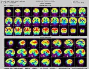 pet-de-paciente-con-epilepsia-frontal Informacion al paciente - temas generales - exploración neurológica - PET de un paciente con epilepsia frontal