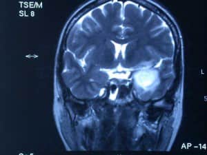 rm-de-craneo-con-tumor-en-lobulo-temporal Informacion al paciente - temas generales - exploracion neurologica -RM de cráneo donde se observa un tumor en la cara interna del lóbulo temporal