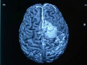 rm-tridimensional-con-tumoracion Informacion al paciente - temas generales - exploración neurológica -RM tridimensional donde se observa una tumoración y su relación con los senos y venas principales