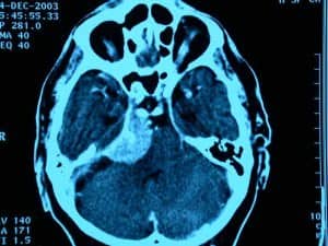 tac-de-craneo-con-tumor-en-fosa-posterior Informacion al paciente - temas generales - exploracion neurologica - Fig- 5.- TAC de cráneo con tumor en la fosa posterior