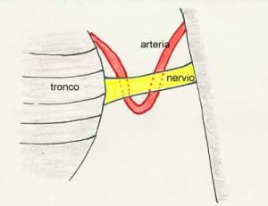 10-esquema.compresion-nervio-trigemino