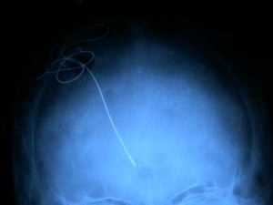 13-rx-control-electrodo-estimulacion-cerebral