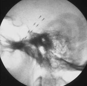 19-rx-control-electrodos-foramen-oval