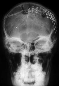 20-rx-control-implantacion-electrodos-subdurales