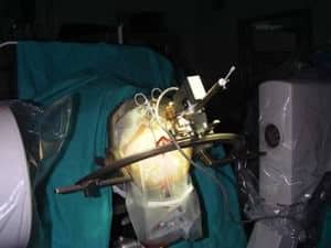 4-colocacion-neuroestimulador-con-estereotaxia