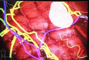 5-campo-quirurgico-superposicion-mapa-cerebral-5