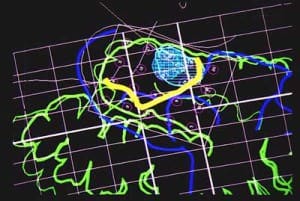 6-campo-quirurgico-superposicion-mapa-cerebral-6