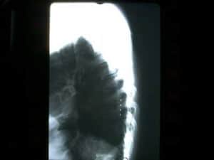 8-rx-tras-colocar-electrodos-estimulacion-medular
