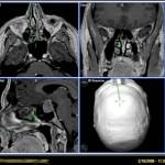 abordaje-transesfenoidal-adenoma-hipofisario informacion al paciente - neuronavegador -abordaje-transesfenoidal-adenoma-hipofisario