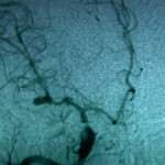 angiografia-cerebral-aneurisma docencia-pregraduados-facultad de medicina uam- angiografia-cerebral-aneurisma