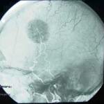 angiografia-cerebral-meningioma docencia-pregraduados-facultad de medicina uam- angiografia-cerebral-meningioma