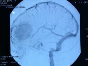 angiografia-cerebral-oligodendroglioma-frontal informacion al paciente-patologia craneoncefalica-gliomas-angiografia de una oligodendroglioma frontal