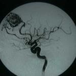 angiografia-malformacion-arterio-venosa docencia-pregraduados-facultad de medicina uam- angiografia-malformacion-arterio-venosa