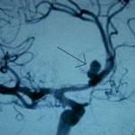 arteriografia-cerebral-aneurisma docencia-pregraduados-facultad de medicina uam- arteriografia-cerebral-aneurisma