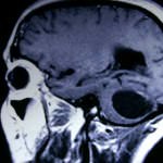 astrocitoma-quistico-cerebelo docencia-pregraduados-facultad de medicina uam- astrocitoma-quistico-cerebelo