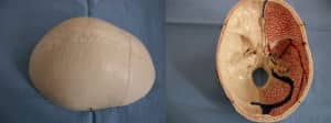 base-de-craneo Información al paciente.-Temas generales.-HIC y Edema Cerebral-base-de-craneo
