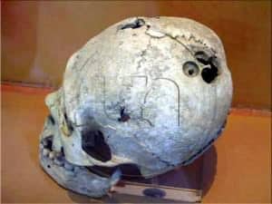craneo-con-orificios-de-trepanacion Cráneo con orificios de trepanación