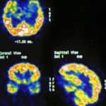 diagnostico-epilepsia-por-pet informacion al paciente - cirugia funcional - cirugia de la epilepsia -diagnostico-epilepsia-por-pet