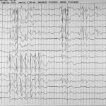diagnostico-epilepsia-por-registro-eeg informacion al paciente - cirugia funcional - cirugia de la epilepsia - diagnostico-epilepsia-por-registro-eeg