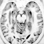 diagnostico-epilepsia-por-rm informacion al paciente - cirugia funcional - cirugia de la epilepsia - diagnostico-epilepsia-por-rm