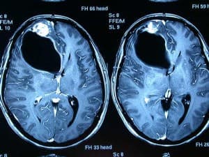 edema informacion al paciente-patologia craneoncefalica-gliomas-edema cerebral