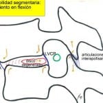 esquema-anterolistesis Informacion al paciente-patologia de la columna vertebral-inestabilidad lumbar-esquema-anterolistesis