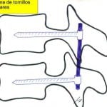 esquema-colocacion-tornillos-transpediculares Informacion al paciente-patologia de la columna vertebral-inestabilidad lumbar-esquema-colocacion-tornillos-transpediculares