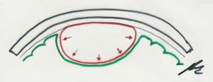 esquema-de-un-meningioma informacion al paciente -patologia craneoencefalica-meningiomas-