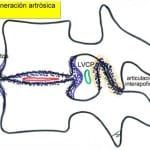 esquema-degeneracion-artrosica Informacion al paciente-patologia de la columna vertebral-inestabilidad lumbar-esquema-degeneracion-artrosica