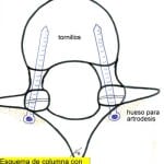 esquema-disposicion-tornillos Informacion al paciente-patologia de la columna vertebral-inestabilidad lumbar-esquema-disposicion-tornillos