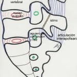 esquema-espondilolisis Informacion al paciente-patologia de la columna vertebral-inestabilidad lumbar-esquema-espondilolisis