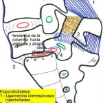esquema-espondilolistesis Informacion al paciente-patologia de la columna vertebral-inestabilidad lumbar-esquema-espondilolistesis