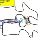 esquema-espondilolistesis-degenracion-artrosica Informacion al paciente-patologia de la columna vertebral-inestabilidad lumbar-esquema-espondilolistesis-degenracion-artrosica