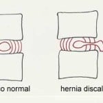 esquema-hernia-discal docencia-pregraduados-facultad de medicina uam- esquema-hernia-discal