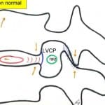 esquema-movimiento-extension Informacion al paciente-patologia de la columna vertebral-inestabilidad lumbar-esquema-movimiento-extension