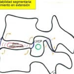 esquema-retrolistesis Informacion al paciente-patologia de la columna vertebral-inestabilidad lumbar-esquema-retrolistesis
