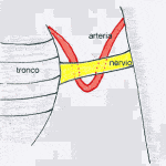 esquema-tronco-cerebral-metodo-jannetta Información al paciente-neurocirugia funcional-neuralgia-del-trigemino-esquema-tronco-cerebral-metodo-jannetta