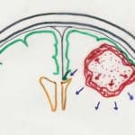 esquema-tumor-crecimiento-hemorragia-intratumoral docencia-pregraduados-facultad de medicina uam- esquema-tumor-crecimiento-hemorragia-intratumoral