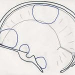 esquemas-distribucion-meningiomas-B docencia-pregraduados-facultad de medicina uam- esquemas-distribucion-meningiomas-B