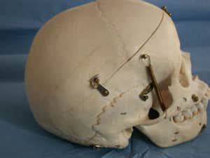 estructura-del-craneo Información al paciente.-Temas generales.-HIC y Edema Cerebral-estructura-del-craneo