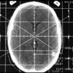 exploracion-radiologica informacion al paciente - cirugia estereotaxica - exploración radiológica