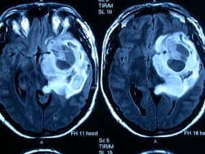 glioma-de-alto-grado informacion al paciente-patologia craneoncefalica-gliomas-de alto grado