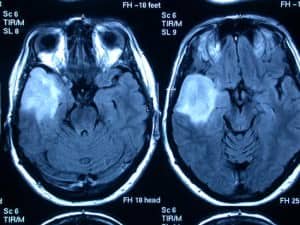 glioma-de-bajo-grado informacion al paciente-patologia craneoncefalica-gliomas-de bajo grado