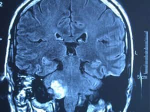glioma-de-tronco informacion al paciente-patologia craneoncefalica-gliomas-glioma de tronco