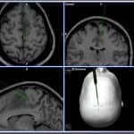 imagen-intraoperatoria-limites-lesion informacion al paciente - neuronavegador -imagen-intraoperatoria-limites-lesion
