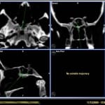 imagen-neuronavegador-extirpacion-tumor-clivus informacion al paciente - neuronavegador -imagen-neuronavegador-extirpacion-tumor-clivus